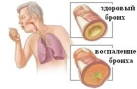 Загострення хронічного бронхіту лікування і препарати