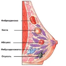 мастопатия