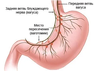 Операція при виразці шлунка показання, післяопераційний період, вартість (післяопераційний) Операція при виразці шлунка показання, післяопераційний період, вартість