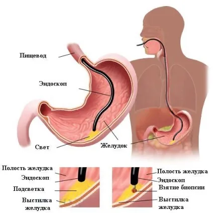 Операція при виразці шлунка показання, післяопераційний період, вартість (виразці) Операція при виразці шлунка показання, післяопераційний період, вартість