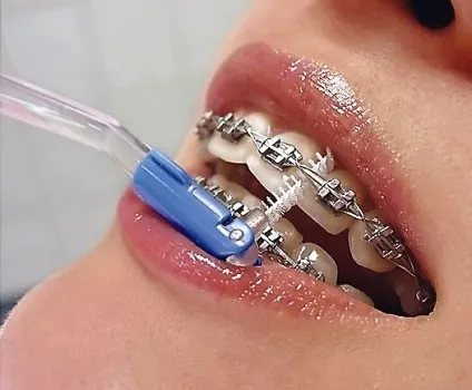 Ортодонтична щітка зубна для брекетів oral b як чистити, купити, ціна (брекетів) Ортодонтична щітка зубна для брекетів oral b як чистити, купити, ціна