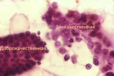 Відмінність злоякісної пухлини від доброякісної (пухлини) Відмінність злоякісної пухлини від доброякісної