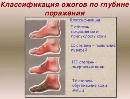 Опіки, ступеня ураження, лікування опіків в домашніх умовах (опіки) Опіки, ступеня ураження, лікування опіків в домашніх умовах