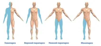 Парез що це таке, причини, симптоматика, лікування явища