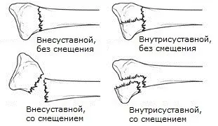 Перелом променевої кістки руки в типовому місці, зі зміщенням, перелом променя, відновлення після