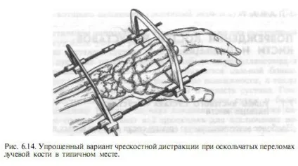 Перелом дистального відділу променевої кістки - хірургія і лікування (кістки) Перелом дистального відділу променевої кістки - хірургія і лікування