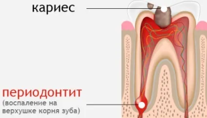 Періодонтит - симптоми і лікування (лікування періодонтиту) Періодонтит - симптоми і лікування