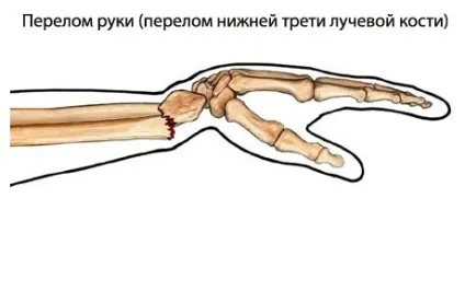 Переломи кісток загальні відомості, eurolab, травматологія (аналізи) Переломи кісток загальні відомості, eurolab, травматологія