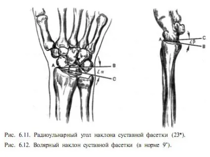 Перелом дистального відділу променевої кістки - хірургія і лікування (перелом) Перелом дистального відділу променевої кістки - хірургія і лікування