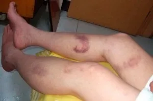 Чому так важко проходять синці на тілі (довго) Чому так важко проходять синці на тілі