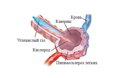 Пневмосклероз легенів лікування народними засобами і дихальна гімнастика, лікувальна фізкультура і (пневмосклероз) Пневмосклероз легенів лікування народними засобами і дихальна гімнастика, лікувальна фізкультура і