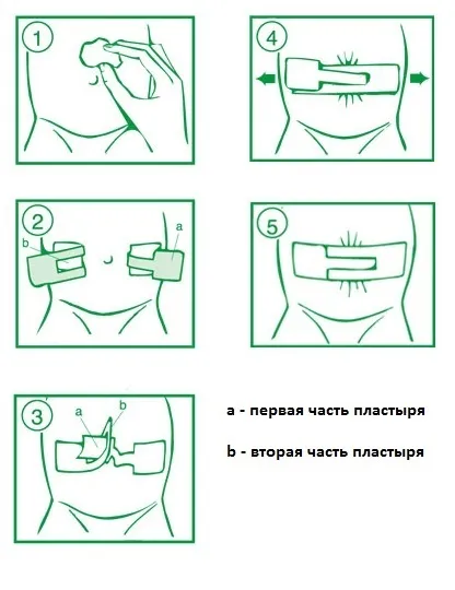 Пластир для пупкової грижі, види пластирів, як їх правильно клеїти ...