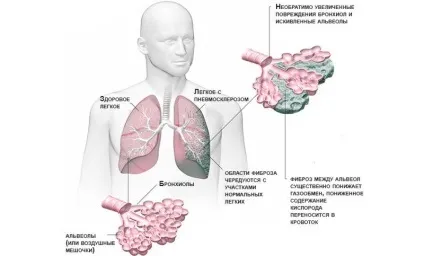 Пневмосклероз легенів лікування народними засобами і дихальна гімнастика, лікувальна фізкультура і (пневмосклероз) Пневмосклероз легенів лікування народними засобами і дихальна гімнастика, лікувальна фізкультура і