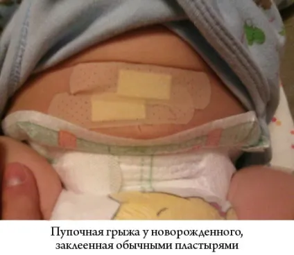 Пластир від пупкової грижі для новонароджених види, як використовувати (пластир) Пластир від пупкової грижі для новонароджених види, як використовувати