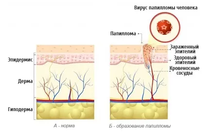 Чому з'являються папіломи (чому) Чому з'являються папіломи