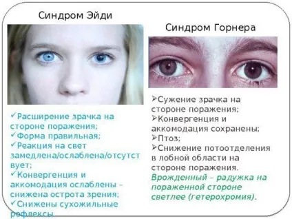 Чому зіниці різного розміру (анізокорія) причини, симптоми, лікування у дорослого і дитини, (різного) Чому зіниці різного розміру (анізокорія) причини, симптоми, лікування у дорослого і дитини,