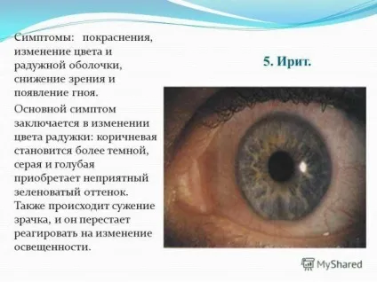 Чому зіниці різного розміру (анізокорія) причини, симптоми, лікування у дорослого і дитини, (анізокорія) Чому зіниці різного розміру (анізокорія) причини, симптоми, лікування у дорослого і дитини,