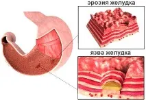 Сорбенти для дітей при отруєннях тому