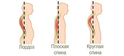 Поперековий лордоз симптоми, діагностика, лікування (лордоз) Поперековий лордоз симптоми, діагностика, лікування