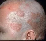 Причини виникнення, симптоми і способи лікування висипань на руках (лікування) Причини виникнення, симптоми і способи лікування висипань на руках