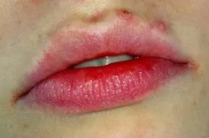 Прищ на губі причини, що робити