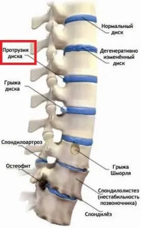 Протрузія дисків хребта види, симптоми, причини, лікування (дисків) Протрузія дисків хребта види, симптоми, причини, лікування