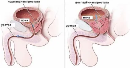 Простатит у чоловіків ознаки і симптоми, як він проявляється (лікування простатиту симптомів) Простатит у чоловіків ознаки і симптоми, як він проявляється