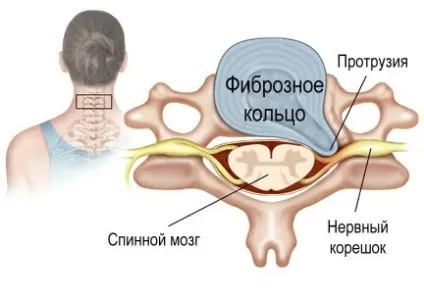 Протрузія дисків хребта види, симптоми, причини, лікування (дисків) Протрузія дисків хребта види, симптоми, причини, лікування