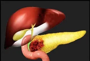 Рак головки підшлункової залози - прогноз (скільки з цим живуть), причини, симптоми, лікування, (підшлункової) Рак головки підшлункової залози - прогноз (скільки з цим живуть), причини, симптоми, лікування,