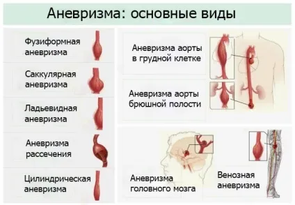 Розширення кровоносних судин (аневризма) види, симптоми, причини, наслідки та методи лікування (симптоми) Розширення кровоносних судин (аневризма) види, симптоми, причини, наслідки та методи лікування