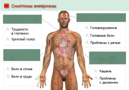 Розширення кровоносних судин (аневризма) види, симптоми, причини, наслідки та методи лікування (кровоносної) Розширення кровоносних судин (аневризма) види, симптоми, причини, наслідки та методи лікування
