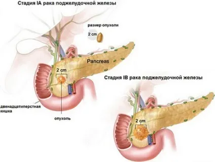 Рак головки підшлункової залози стадії, симптоми і лікування онкології (головки) Рак головки підшлункової залози стадії, симптоми і лікування онкології