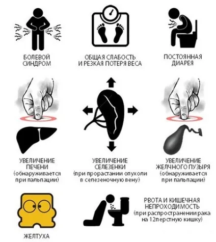 Рак головки підшлункової залози симптоми, лікування і прогноз (симптоми) Рак головки підшлункової залози симптоми, лікування і прогноз