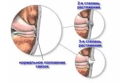 Розтягнення зв'язок руки симптоми і лікування (лікування) Розтягнення зв'язок руки симптоми і лікування