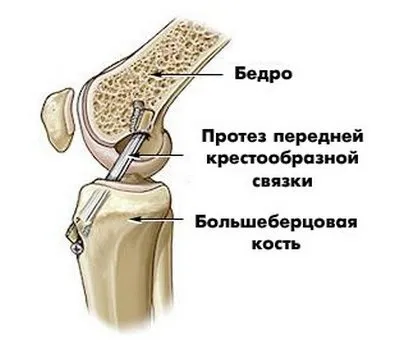 Розрив зв'язок коліна - лікувати або оперувати (розрив) Розрив зв'язок коліна - лікувати або оперувати
