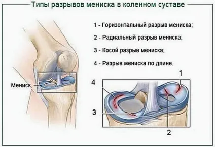Розрив меніска колінного суглоба - симптоми і лікування (суглоба) Розрив меніска колінного суглоба - симптоми і лікування