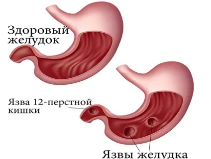 Рефлюкс езофагіт причини і лікування, симптоми і що це таке