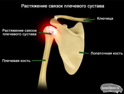 Розтягнення зв'язок плечового суглоба причини, симптоми і лікування (зв'язок) Розтягнення зв'язок плечового суглоба причини, симптоми і лікування