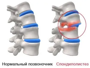 Ретролістез l5 хребця що це таке, причини захворювання і лікування (хребця) Ретролістез l5 хребця що це таке, причини захворювання і лікування