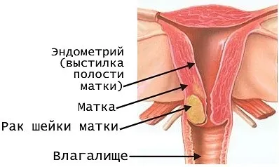 Рекомендації після припікання ерозії що не можна робити (ерозії) Рекомендації після припікання ерозії що не можна робити