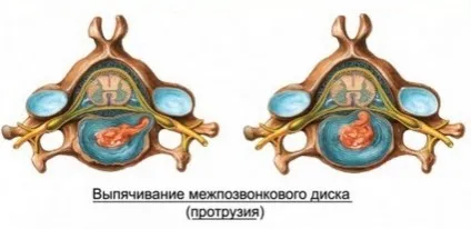 Ретролістез l5 хребця що це таке, причини захворювання і лікування (захворювання) Ретролістез l5 хребця що це таке, причини захворювання і лікування