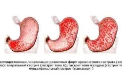 блювота кислотою