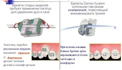 Самолігуючі брекети як виглядає система, фото (система) Самолігуючі брекети як виглядає система, фото