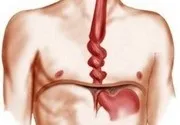 Cauzele, semnele, simptomele și tratamentul spasmului esofagian