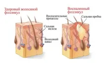 Стадії акне (загострення форми та ступеня акне) форми