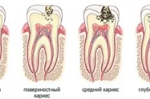 Середній карієс діагностика та лікування карієсу