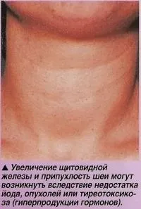 Щитовидна і паращитовидної залози (знання - анатомія людини) (щитовидна) Щитовидна і паращитовидної залози (знання - анатомія людини)