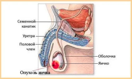 Семинома яєчка симптоми, стадії, прогноз