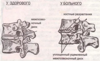 Шийний спондильоз види, причини, симптоми і лікування (спондильоз) Шийний спондильоз види, причини, симптоми і лікування