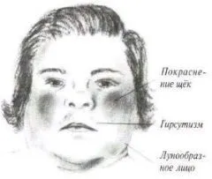 Синдром Іценко-Кушинга симптоми, лікування і причини хвороби (Іценко-Кушинга) Синдром Іценко-Кушинга симптоми, лікування і причини хвороби